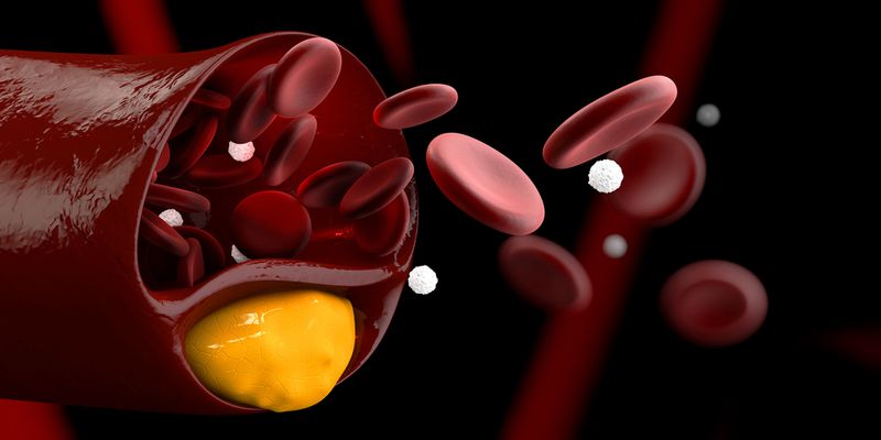 familial hypercholesterolemia