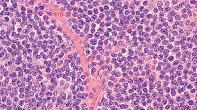 Mantle Cell Lymphoma