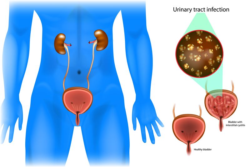 complicated urinary tract infections (cUTI)