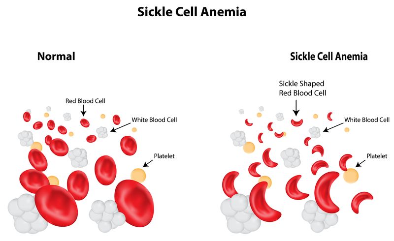 Sickle Cell Disease