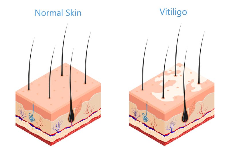 Vitiligo