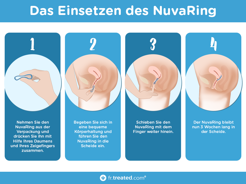 EluRyng™ nuvaring