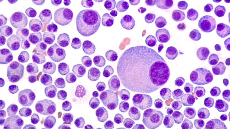 Multiple Myeloma Multiple Myeloma