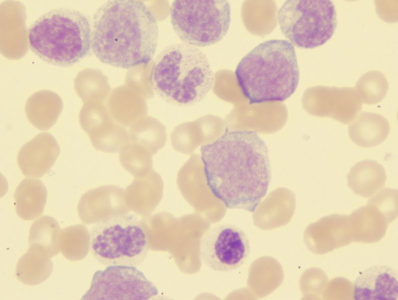 chronic myelomonocytic leukemia (CMML) chronic myelomonocytic leukemia (CMML)