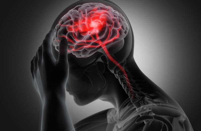 Migraine Migraine