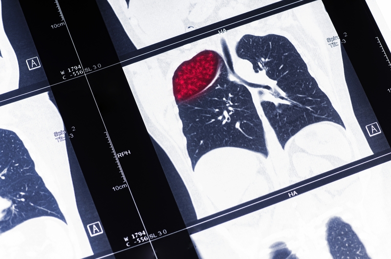 Non-Small Cell Lung Cancer Non-Small Cell Lung Cancer