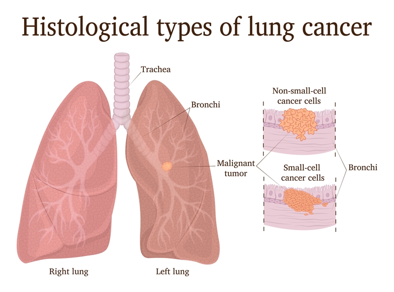 non-small cell lung cancer (NSCLC).