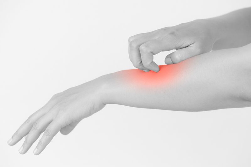 Atopic Dermatitis Atopic Dermatitis