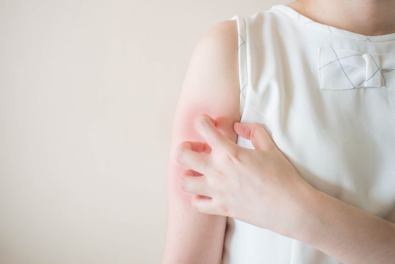 Chronic Idiopathic Urticaria (CIU) Chronic Idiopathic Urticaria (CIU)