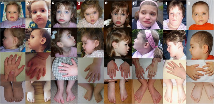 CDKL5 Deficiency Disorder (CDD) CDKL5 Deficiency Disorder (CDD)