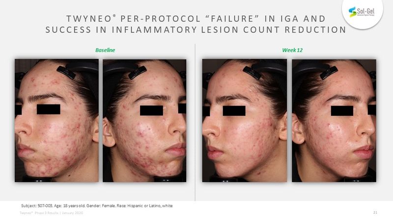 Twyneo (tretinoin and benzoyl peroxide