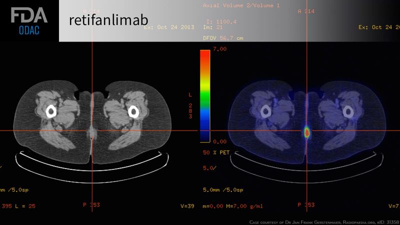 Retifanlimab for the Treatment of Certain Patients with Squamous Cell Carcinoma of the Anal Canal (SCAC) Retifanlimab for the Treatment of Certain Patients with Squamous Cell Carcinoma of the Anal Canal (SCAC)