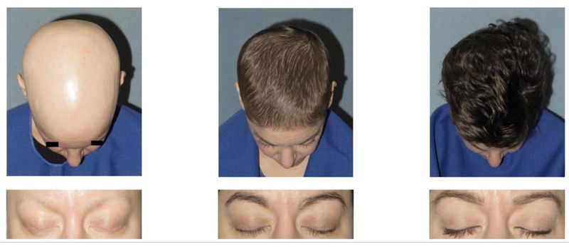Alopecia Areata Alopecia Areata