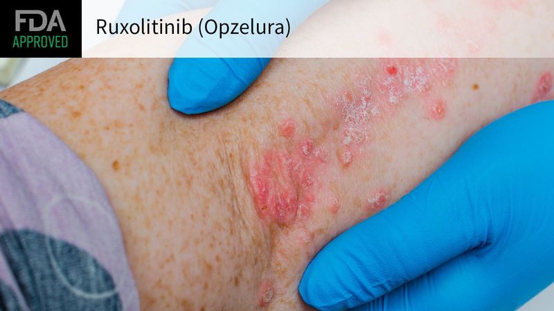 Opzelura (ruxolitinib) Opzelura (ruxolitinib)
