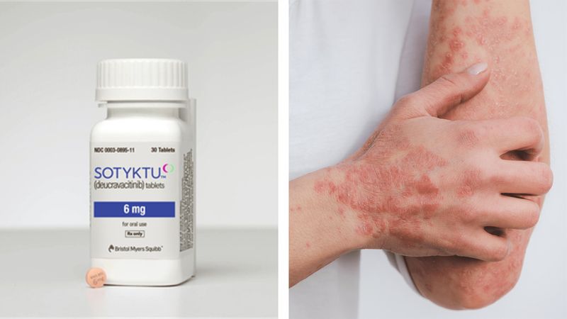 Sotyktu (deucravacitinib) Sotyktu (deucravacitinib)