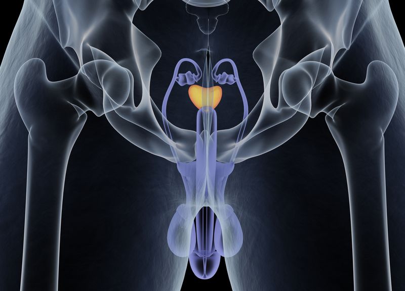Prostate Cancer Prostate Cancer