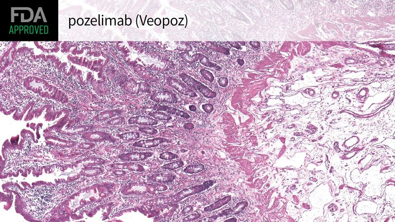 Veopoz (pozelimab-bbfg) Veopoz (pozelimab-bbfg)