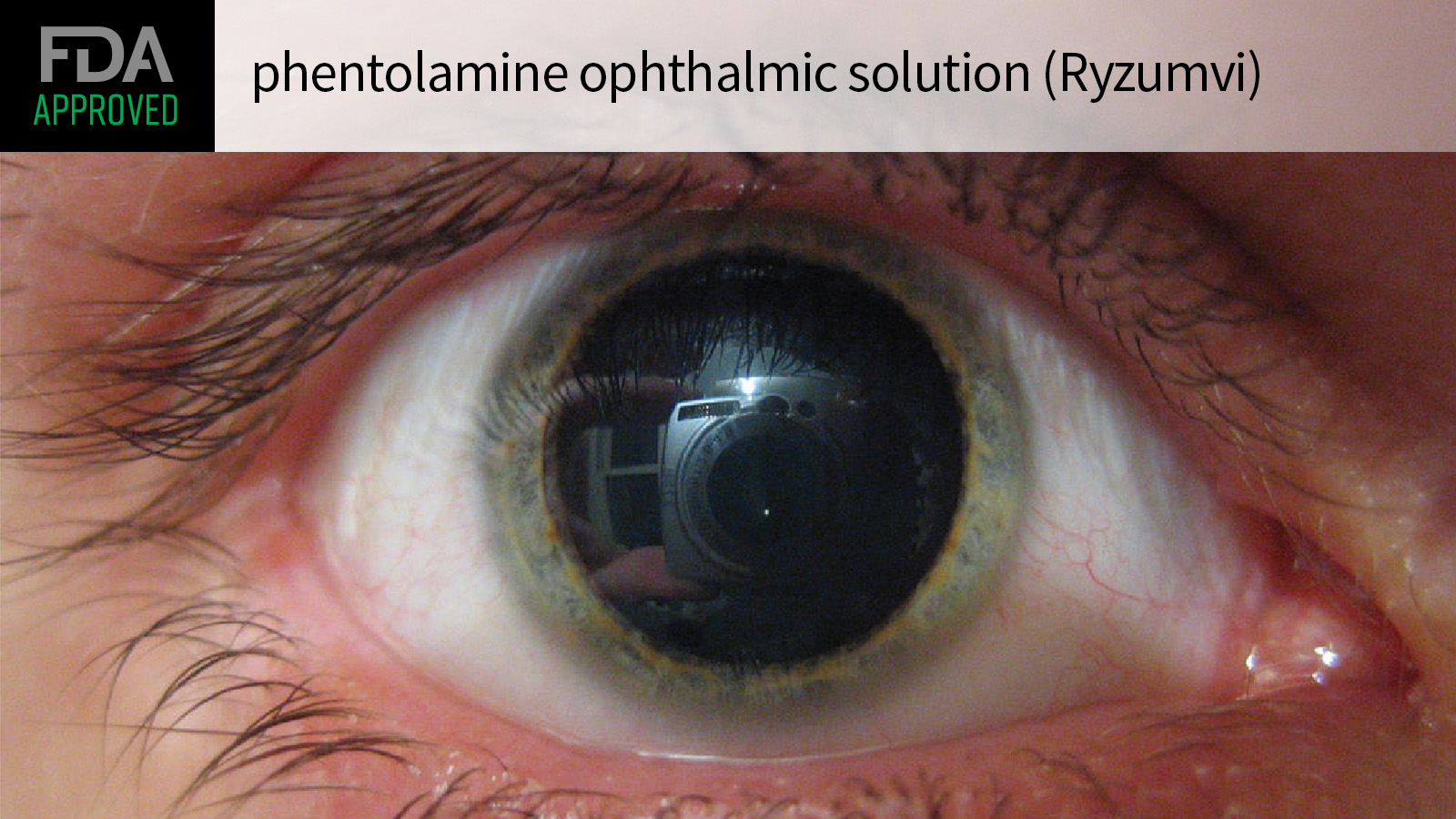 Ryzumvi (Phentolamine Ophthalmic Solution) Ryzumvi (Phentolamine Ophthalmic Solution)