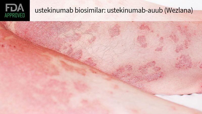 Wezlana (ustekinumab-auub) Wezlana (ustekinumab-auub)