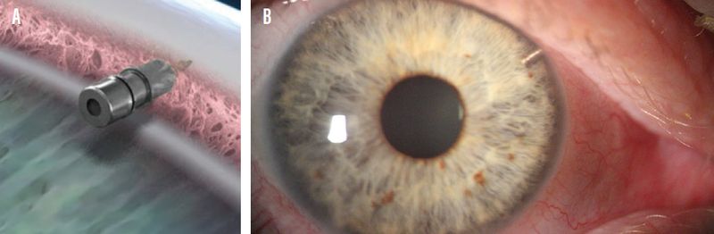 iDose TR (travoprost intracameral implant) iDose TR (travoprost intracameral implant)