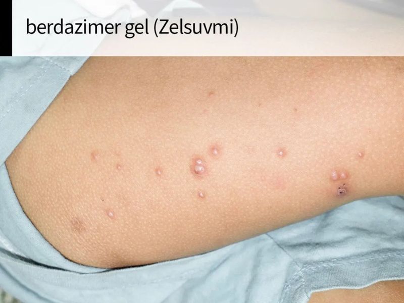 Zelsuvmi (berdazimer topical gel) Zelsuvmi (berdazimer topical gel)