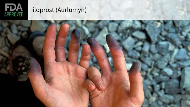 Aurlumyn (iloprost) Aurlumyn (iloprost)