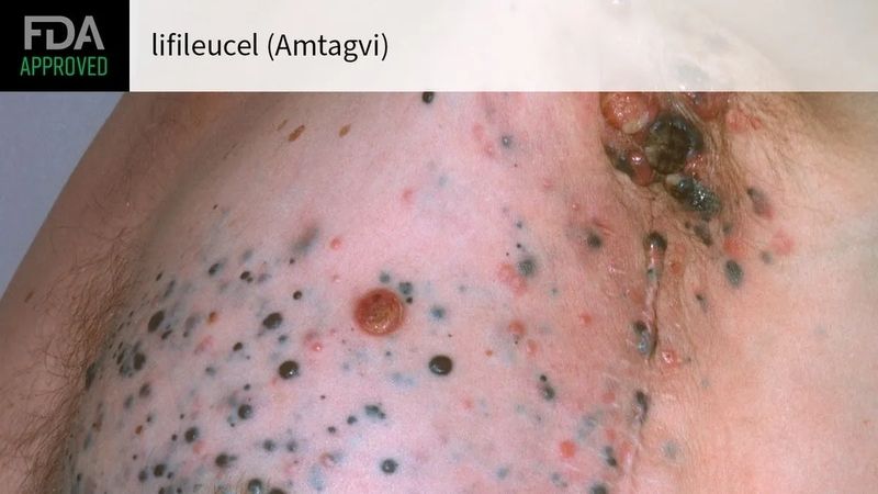 Amtagvi (lifileucel) Amtagvi (lifileucel)