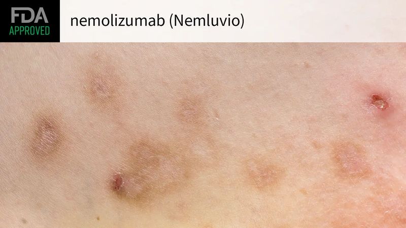 Nemluvio (nemolizumab) Nemluvio (nemolizumab)